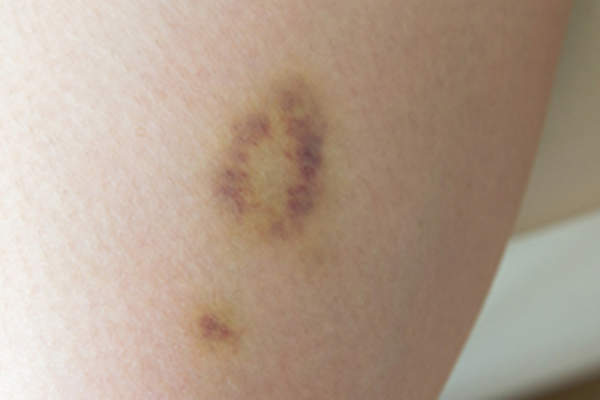 bruise on leg