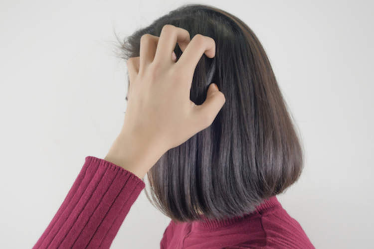 Eczema of the scalp, causing itchy head.