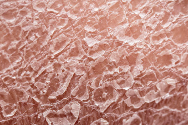 Close-up on flakey eczema skin.