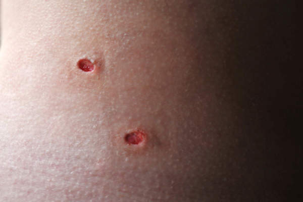 Close up of two punch biopsy wounds.