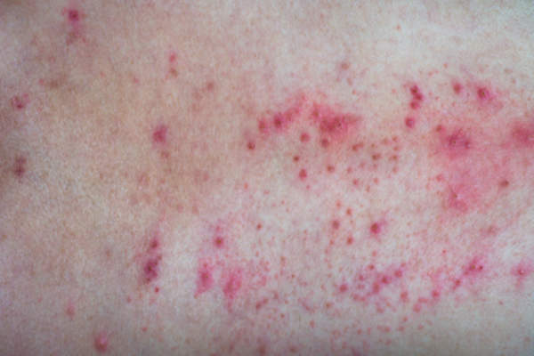 rash