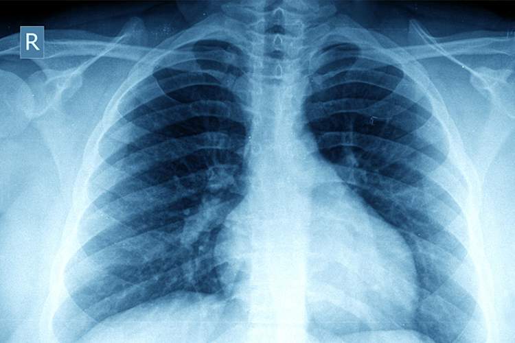 Chest X-ray in obese person.