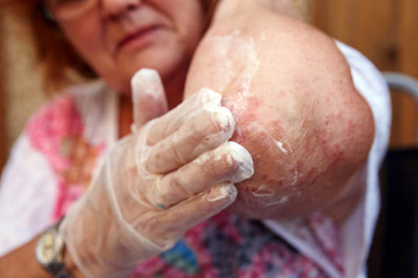 Woman applying topical steroid cream to elbow eczema.
