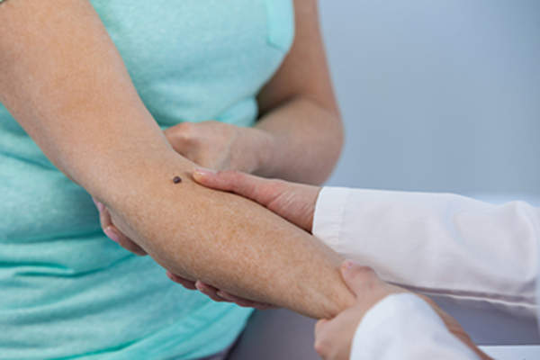Dermatologist examining a mole on a patient.