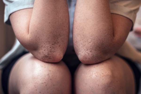 elbows and knees