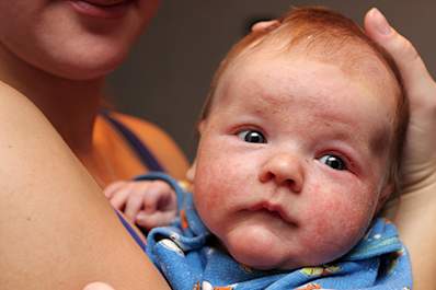 Baby has eczema on his face.