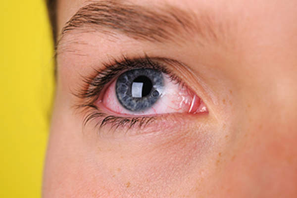 Young woman with red, inflamed eye.