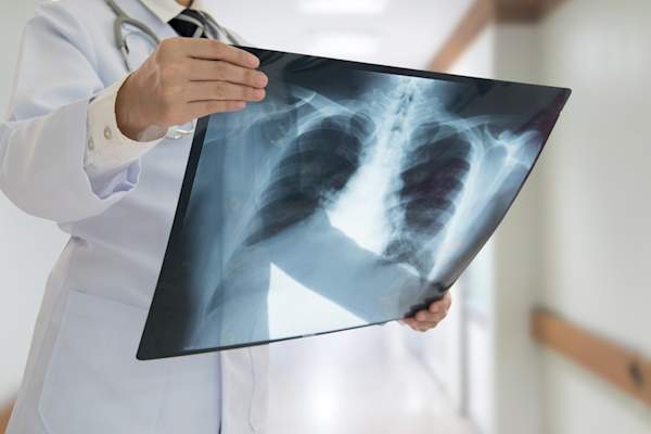 Doctor looking at chest x-ray.