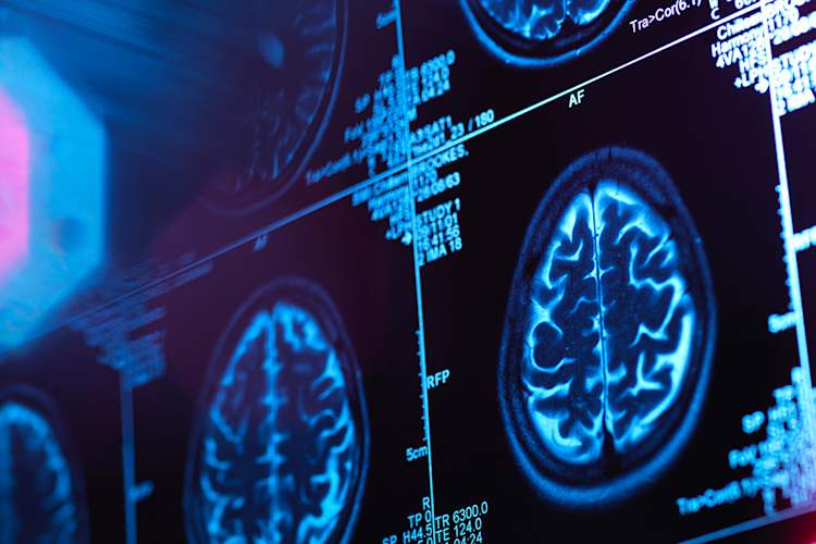 Brain scan