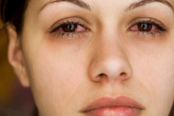 Woman with a lot of redness in whites of eyes.