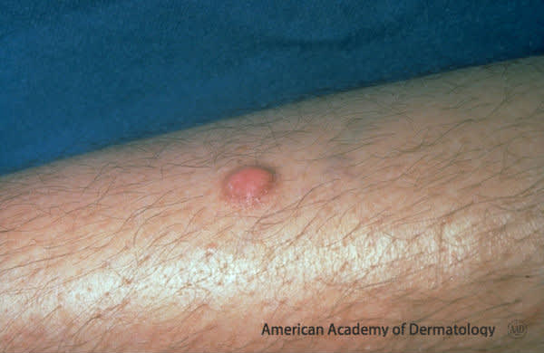 Dermatofibroma 3037 copy