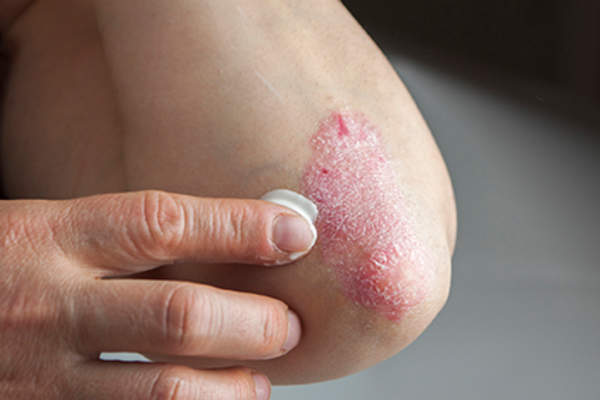 Rubbing ointment on elbow psoriasis.
