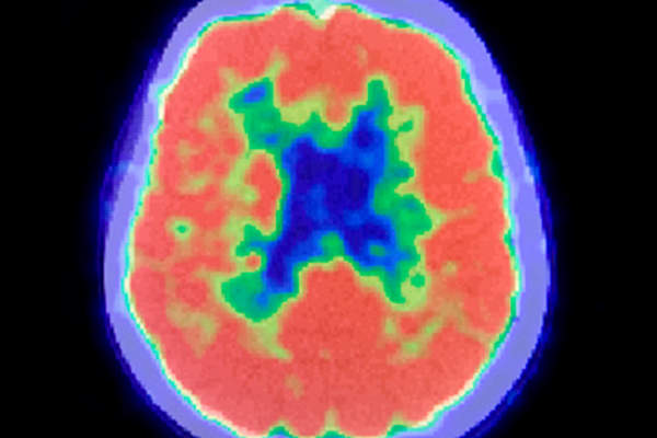 Human Brain PET Scan.