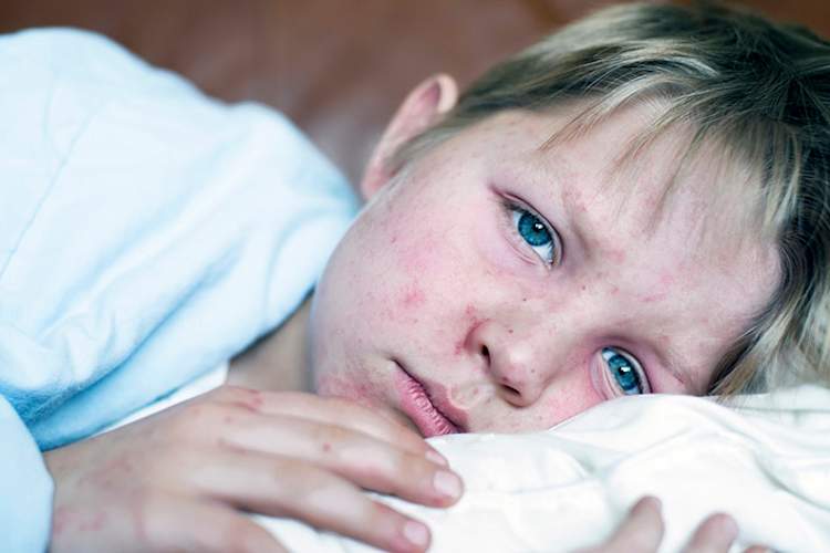 Boy sick with measles.