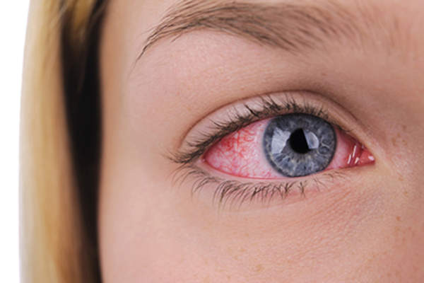 Young woman with red, irritated eye.