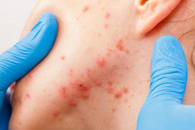 Doctor examines adult female acne.
