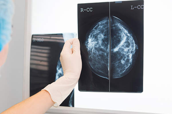 Mammogram image.