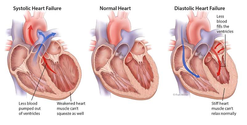 Systolic heart failure guide
