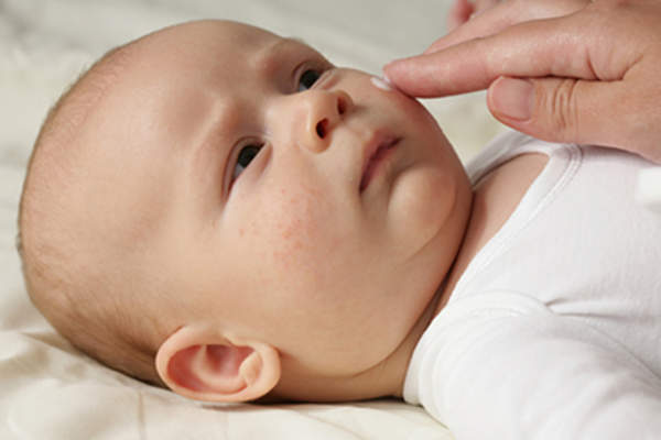 Mother putting lotion on face of infant with eczema.