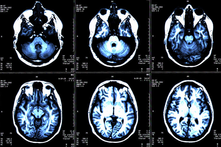 MS brain scan