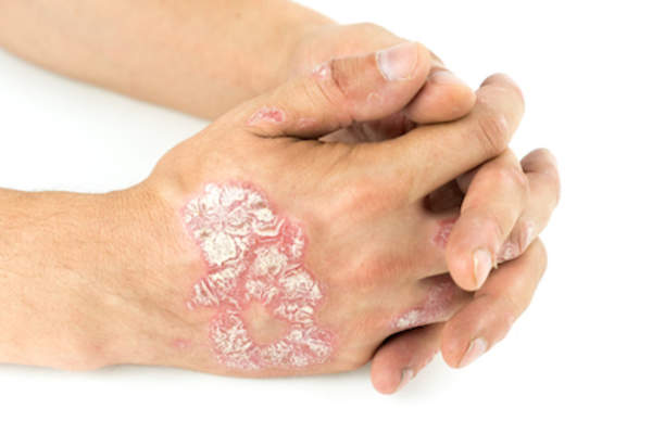 Psoriasis vulgaris on the male hands.