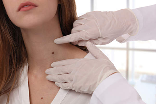 Doctor examining a mole.