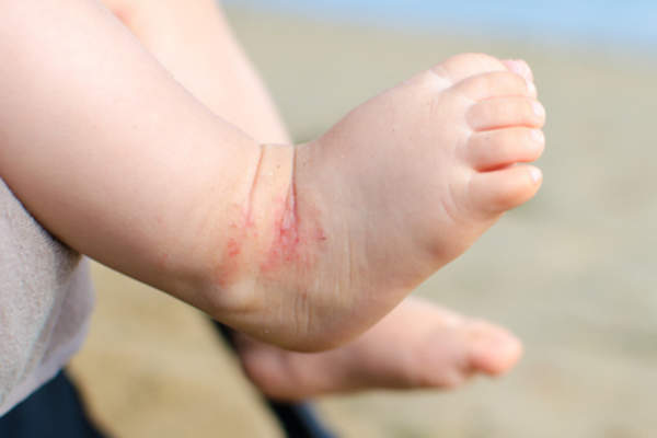 Baby foot with eczema.