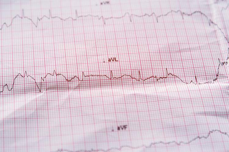 Electrocardiogram