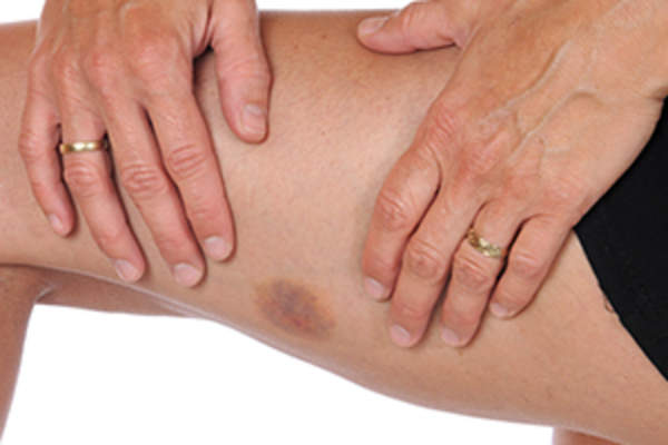 bruise on upper thigh