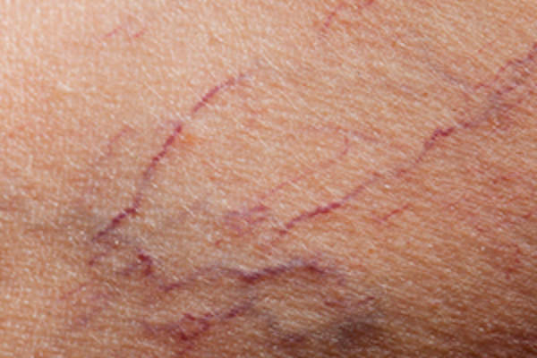 broken blood vessels in leg