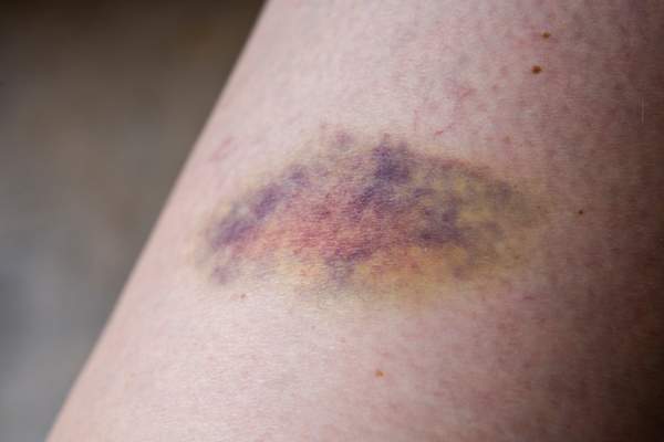 close up of bruise