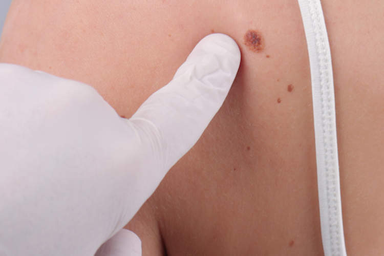 Melanoma Cancer Can Return: What to Know