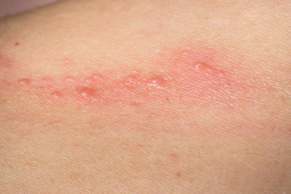 Molluscum type bumbs