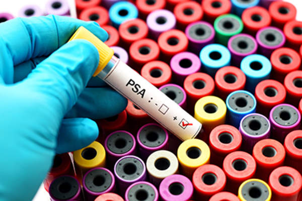 Prostate-specific antigen test.
