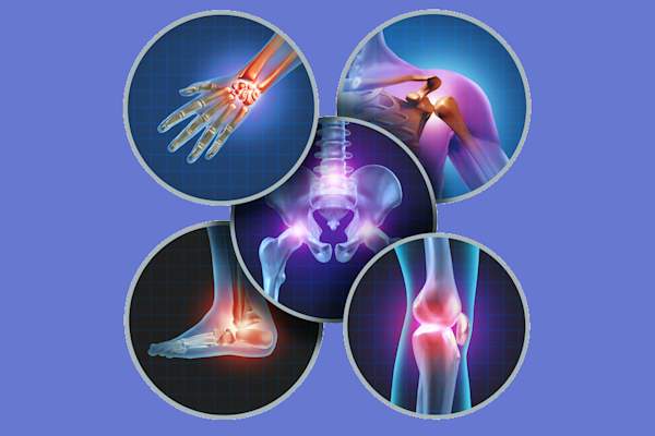 Joint inflammation