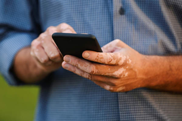 Man with vitiligo on hands using phone.