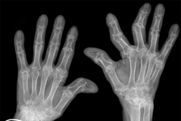 X-ray of hands with rheumatoid arthritis.