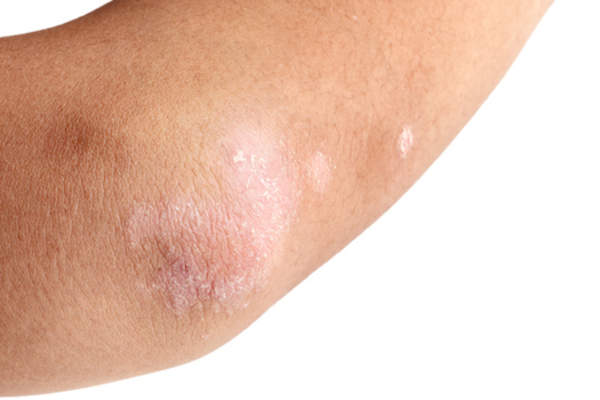 Psoriasis on arm