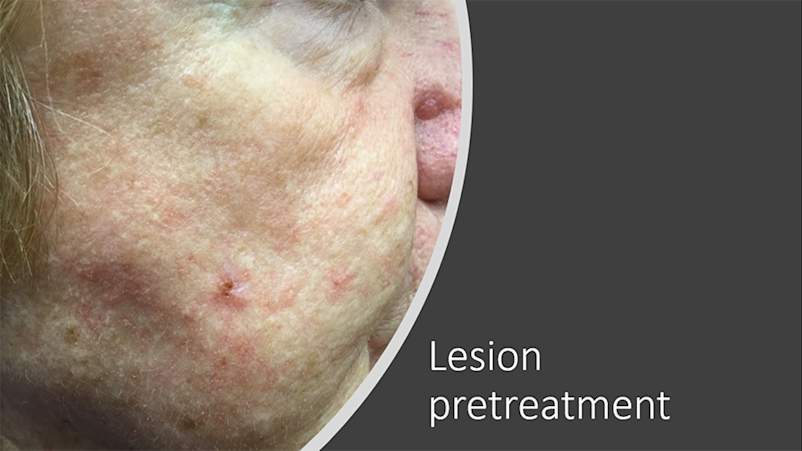 Lesion pretreatment