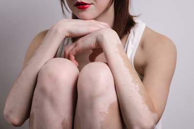 Girl with vitiligo on arms and legs.