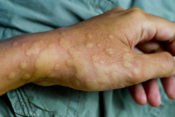 Hives on a hand.