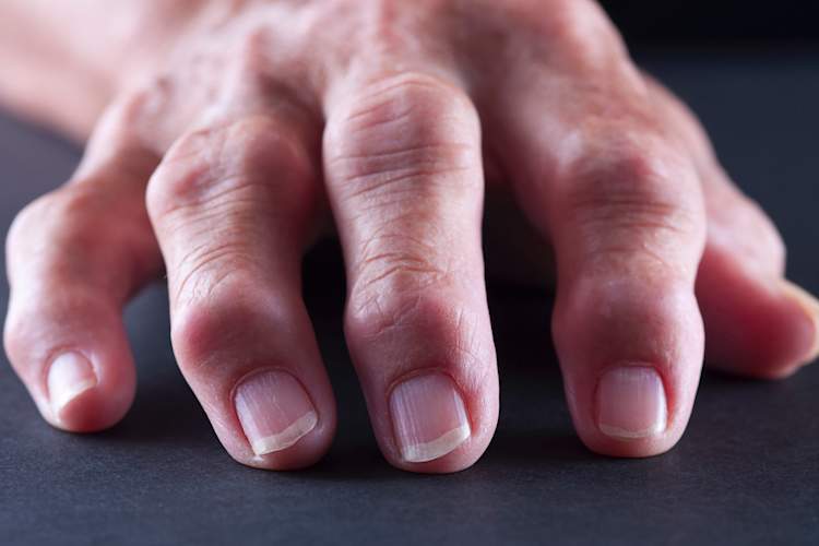 joints swollen