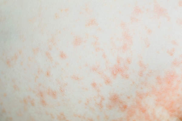 Contact dermatitis.