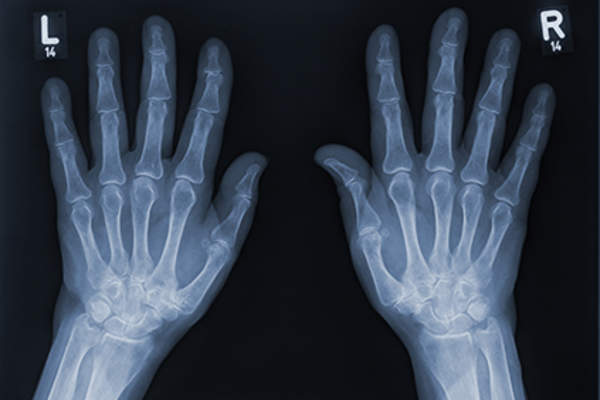 Hand x-rays.