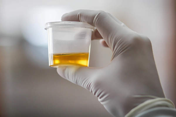 Urine sample.