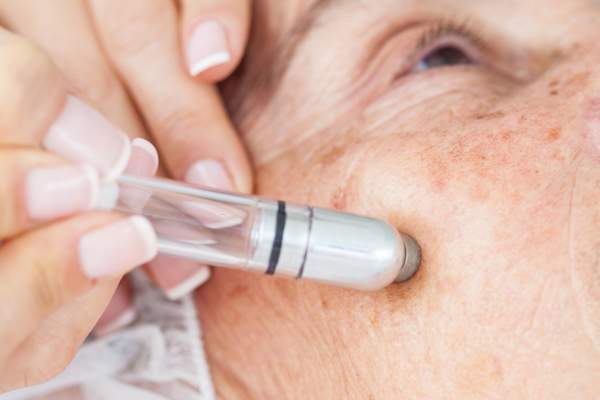 woman with age spots getting Microdermabrasion treatment