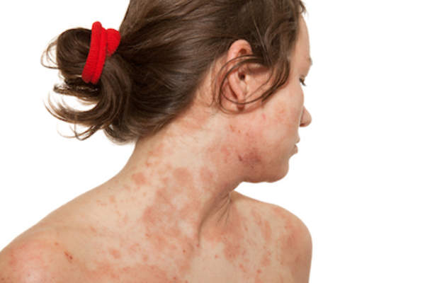 A woman with atopic dermatitis.