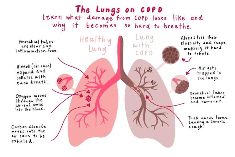 Lungs on COPD