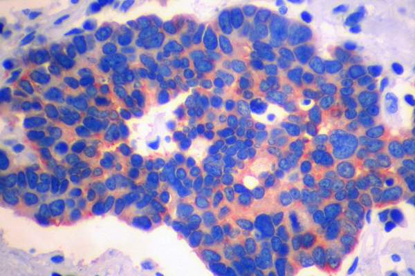 Chromogranin immunostain of small cell lung carcinoma