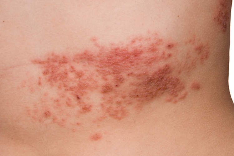 Shingles on body